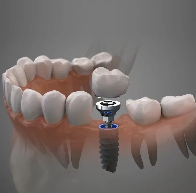 Cấy Ghép Implant